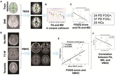 Integrating Structural and Functional Interhemispheric Brain Connectivity of Gait Freezing in Parkinson's Disease